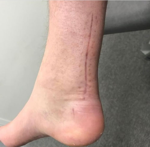 Post Surgery ankle