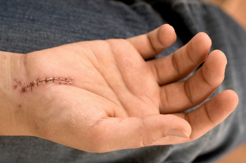 Post-Surgery-hand Post Surgery hand