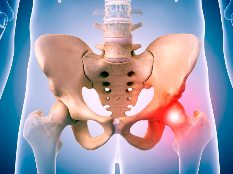 Stock_Hip2 Hip injury