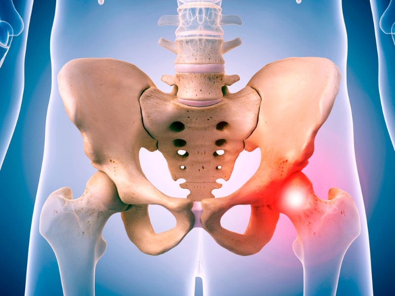 Hip injury