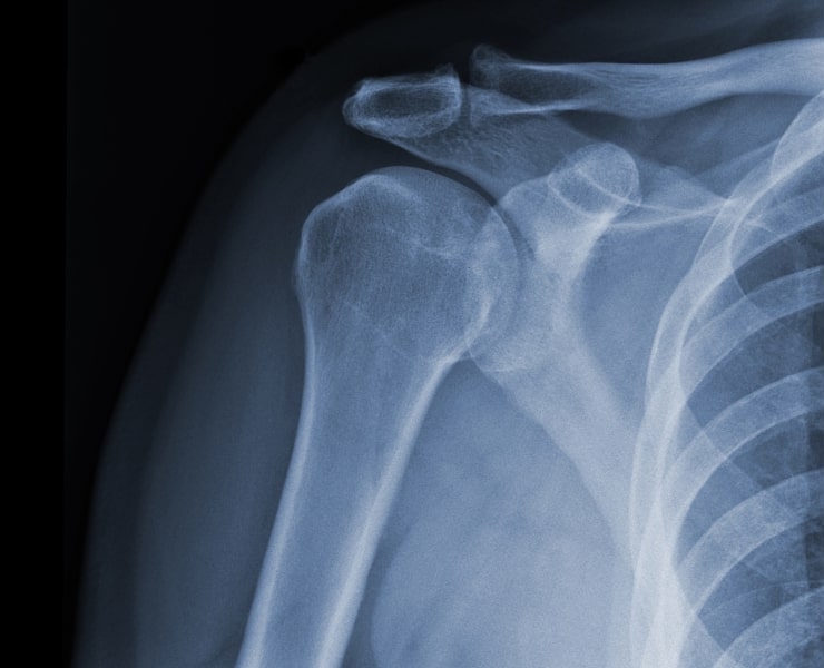 stock shoulder2 shoulder injury