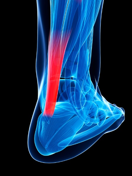 tendon-injury4 tendon injury