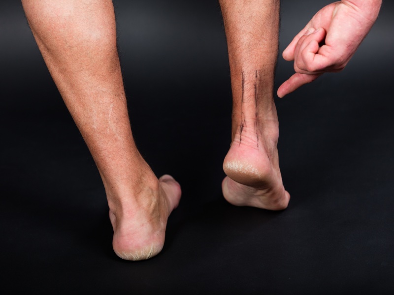 tendon-injury5 tendon injury